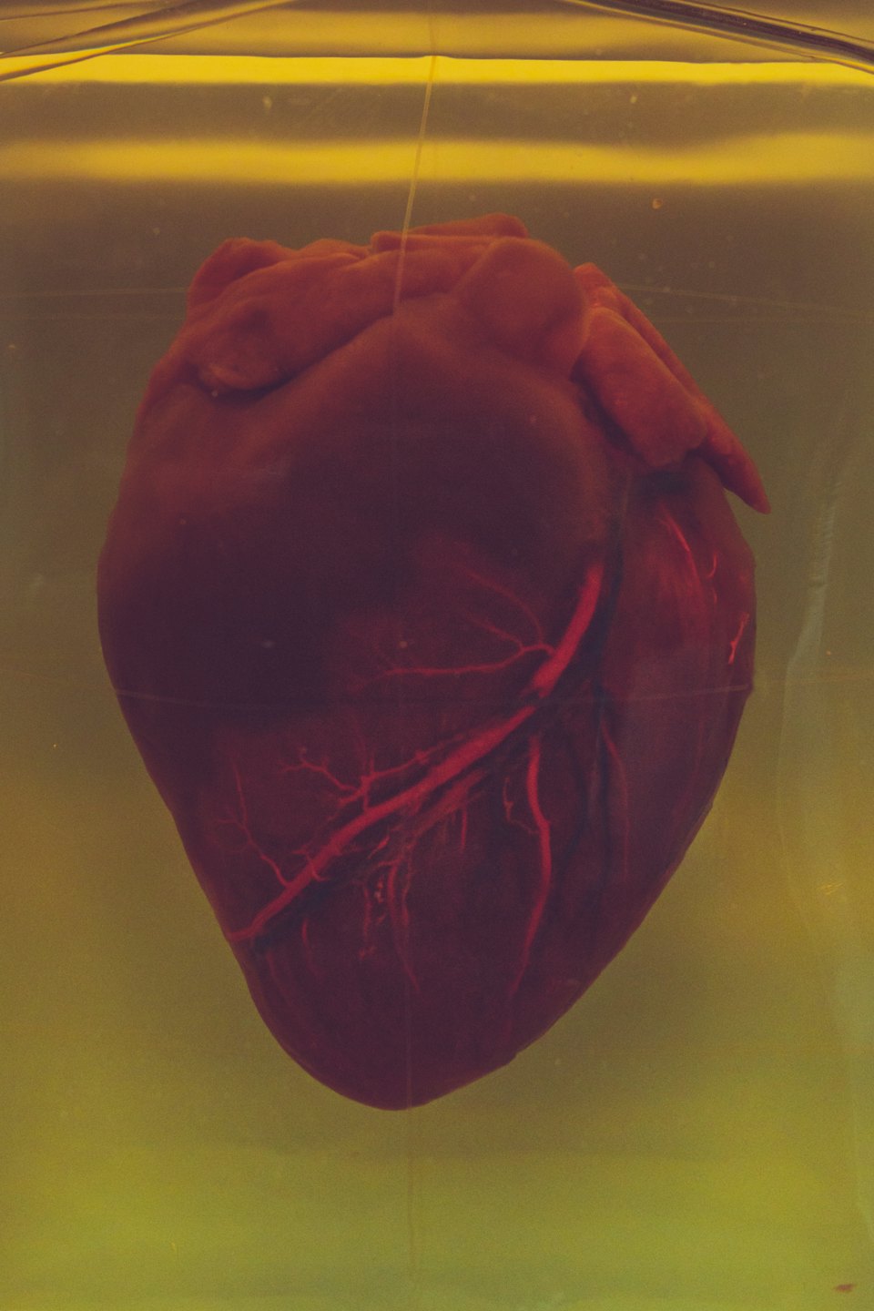 Corazón humano con arterias y venas visibles en líquido de conservación.